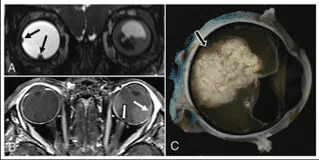 Retinoblastoma tudo que você precisa saber neurosky