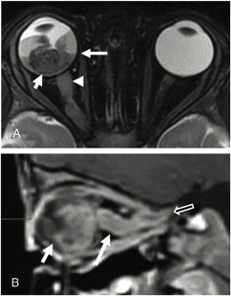 Retinoblastoma tudo que você precisa saber neurosky