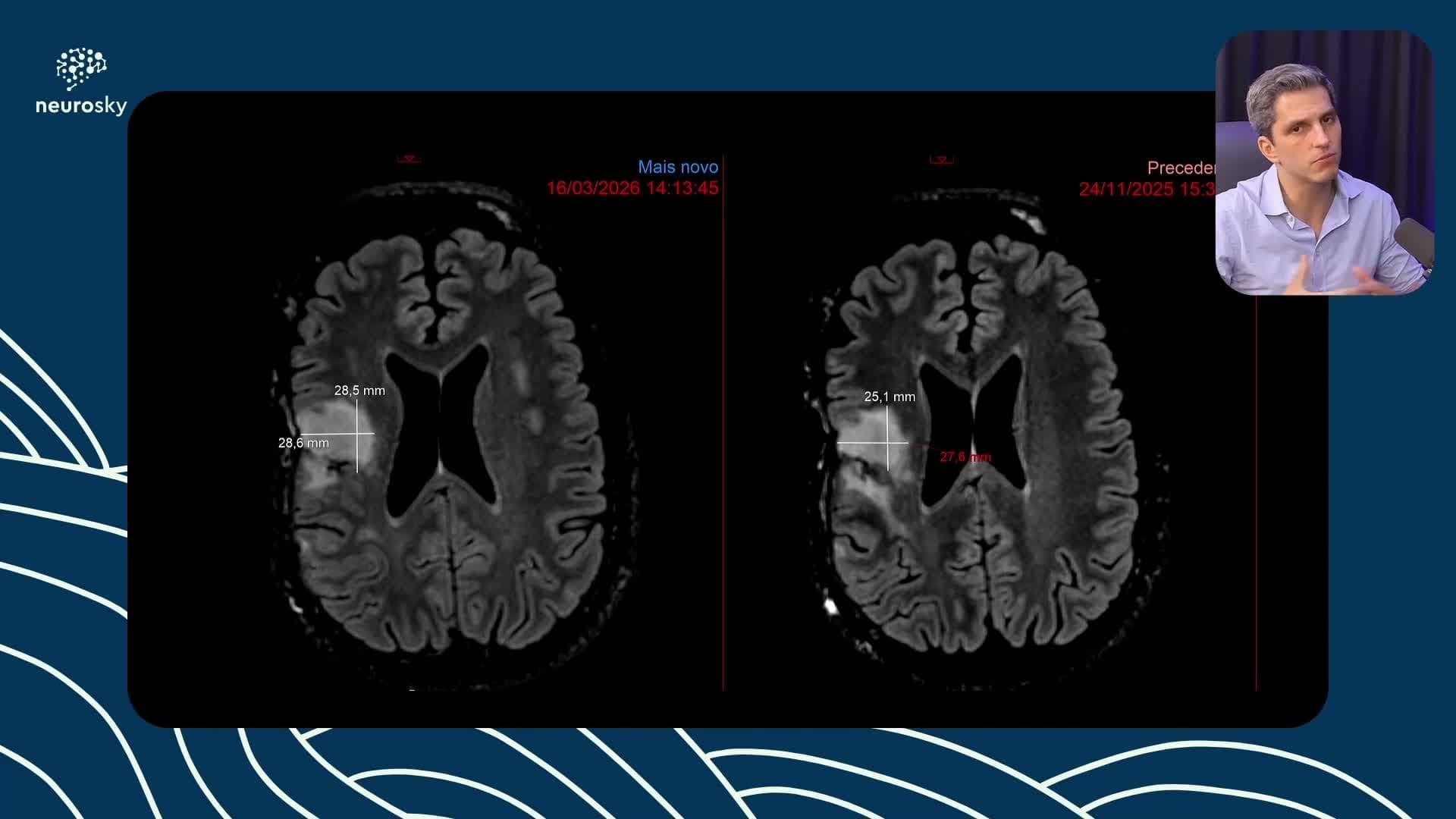 Glioma Difuso Adulto de Baixo Grau 2026 Parte 2