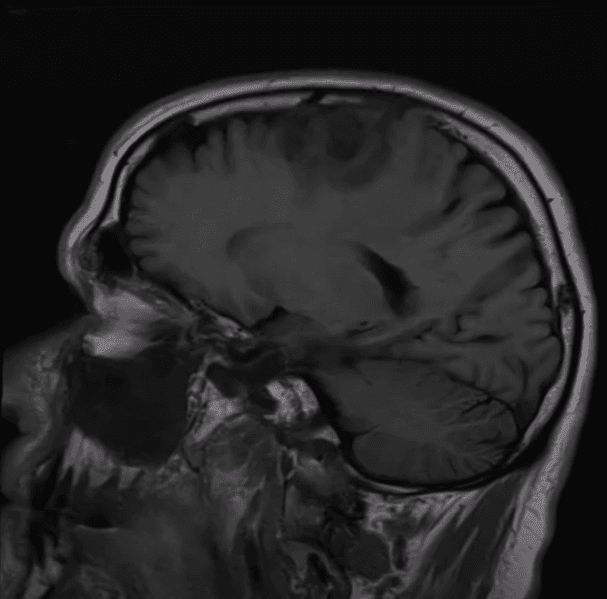 Tumor ou não tumor?