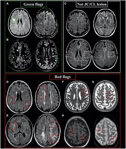 Guidelines Para A Avaliacao Por Ressonancia Magnetica Das Lesoes Na Esclerose Multipla Neurosky