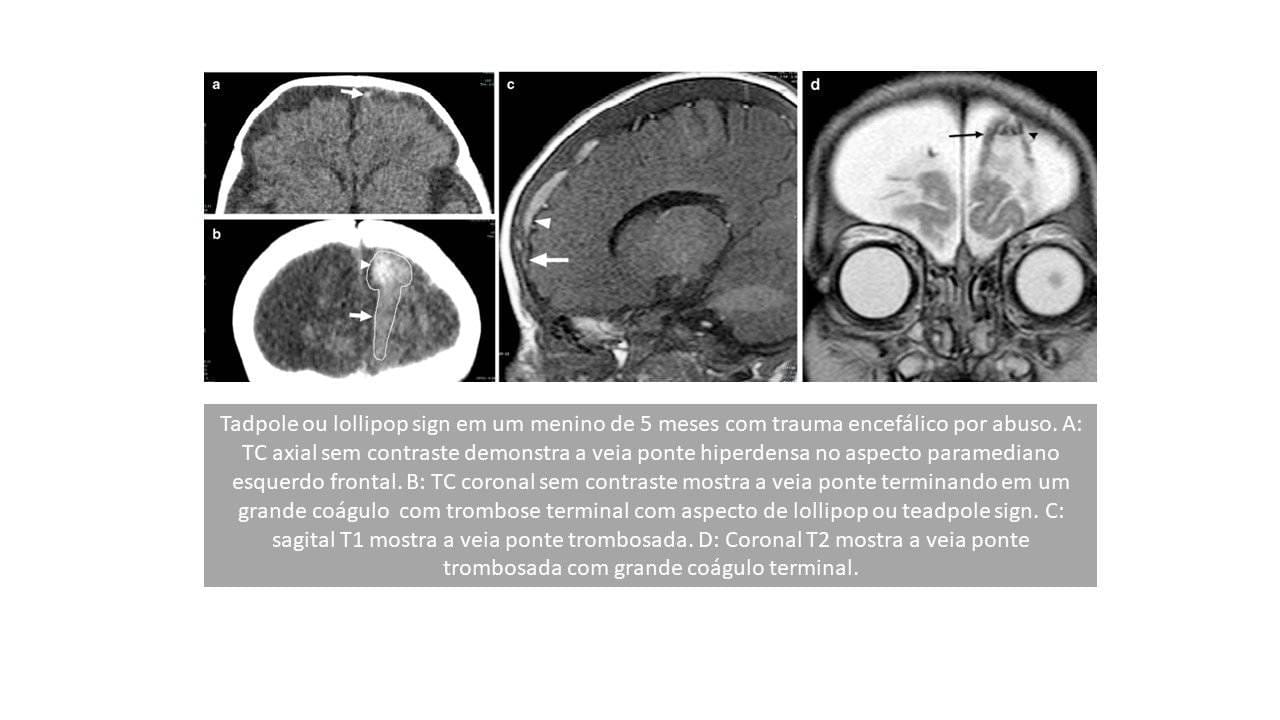 Lesão venosa no trauma cranioencefálico por agressão infantil - Aspectos de imagem 1 Slide1 3