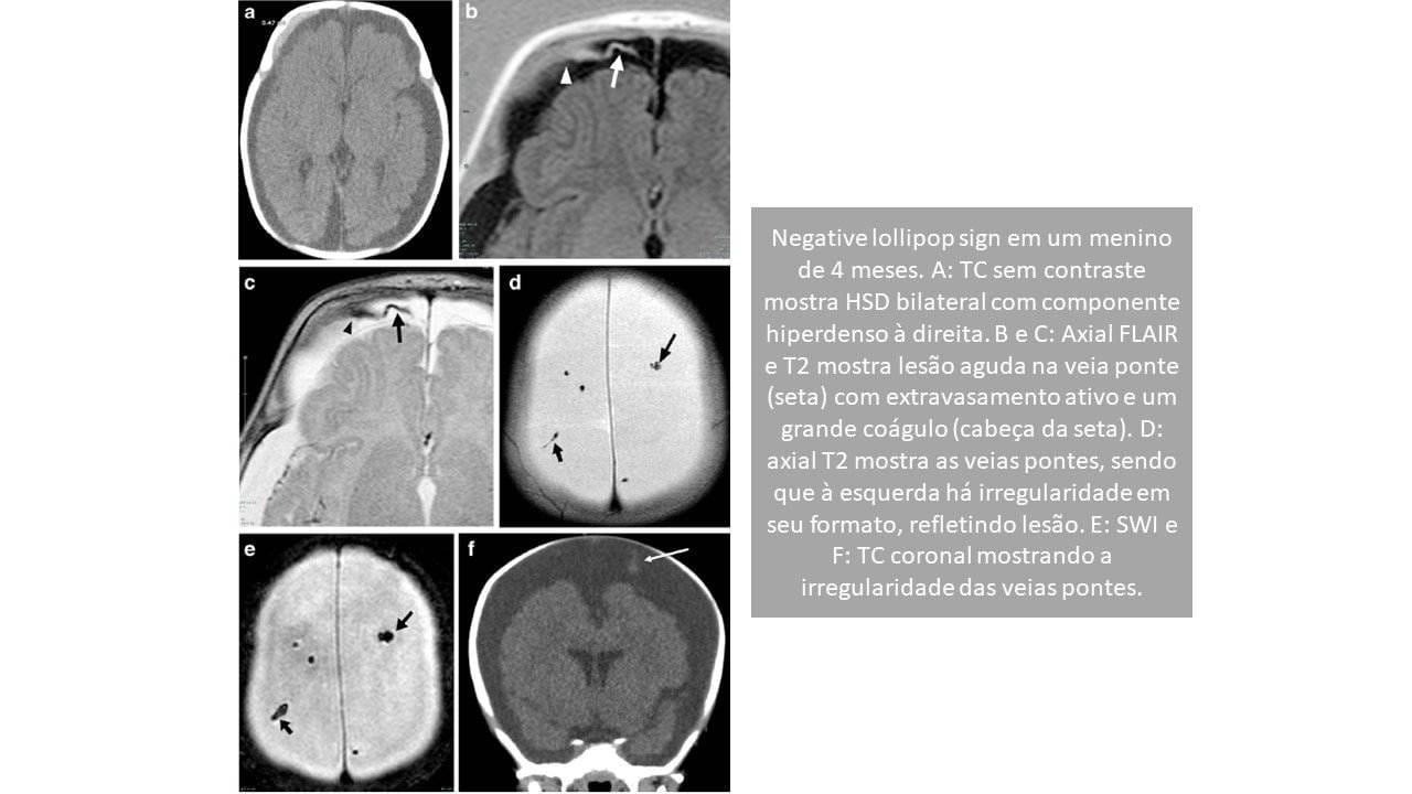 Lesão venosa no trauma cranioencefálico por agressão infantil - Aspectos de imagem 2 Slide2 2