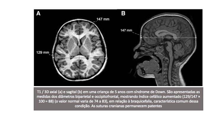Neuroimagem na Síndrome de Down 1 Slide1