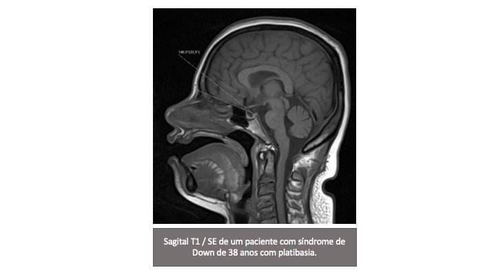 Neuroimagem na Síndrome de Down 2 Slide2