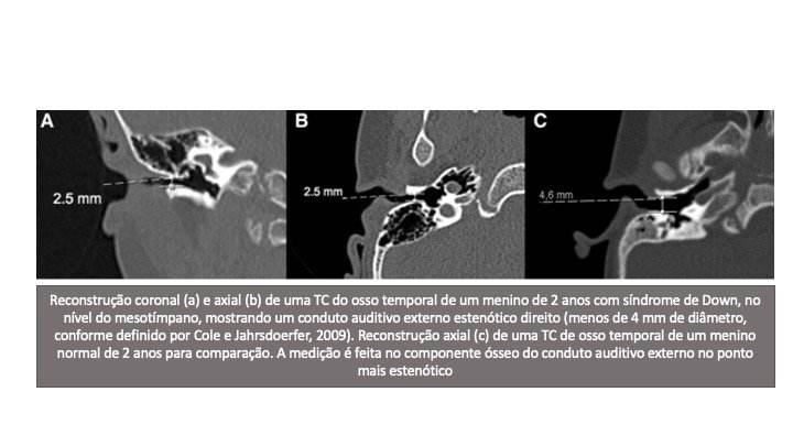 Neuroimagem na Síndrome de Down 3 Slide3