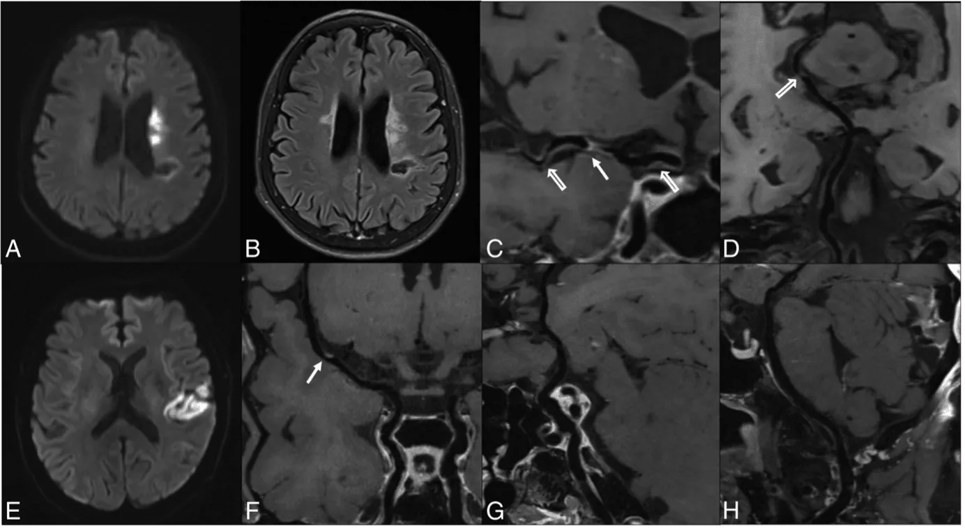Quais características das placas ateromatosas intracranianas podem predizer  o risco de AVCi recorrente? – neurosky