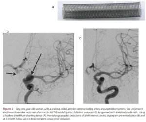 Manejo de aneurismas cerebrais incidentais não rotos 4 DIVERSOR