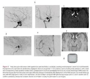 Manejo de aneurismas cerebrais incidentais não rotos 5 INTRASACULAR