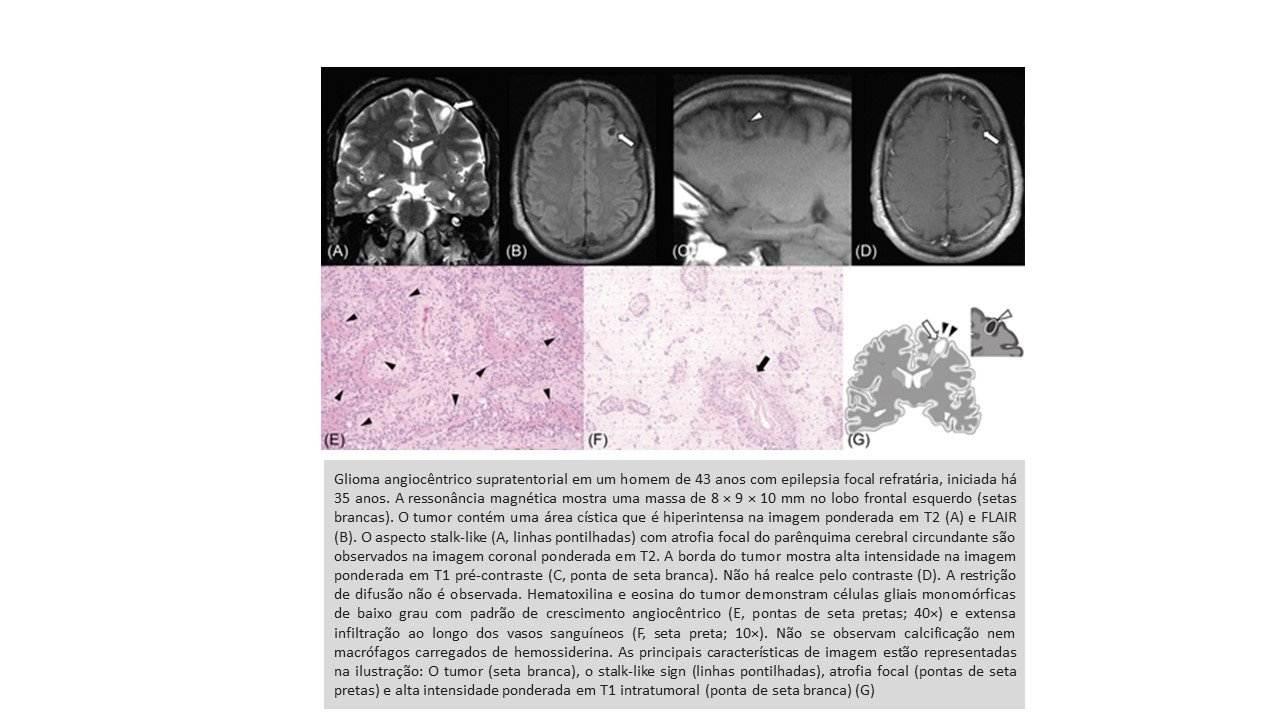 Características de neuroimagem do glioma angiocêntrico 2 Slide2