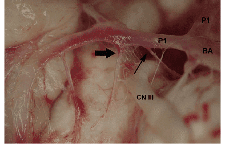 The right P1 segment showing the origin of the thalamoperforating thin arrow and the