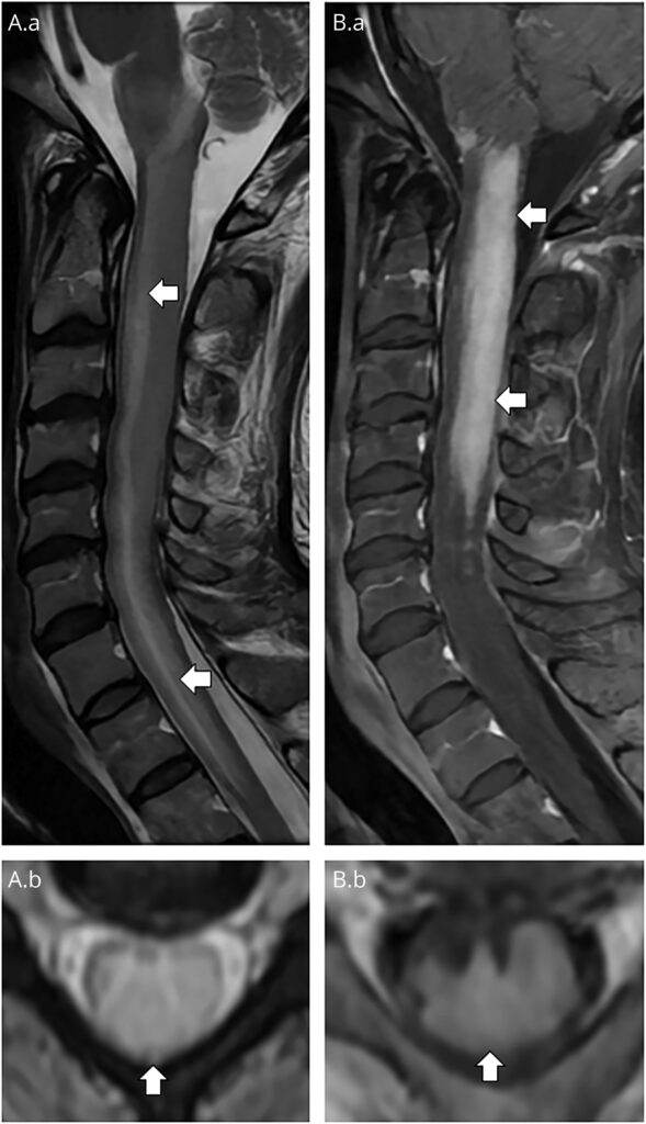 skychallenge 33 neurology linfoma medula sinal tridente 1