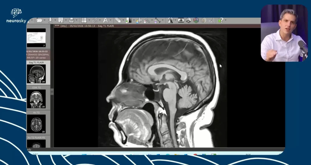 Hipertensao Intracraniana