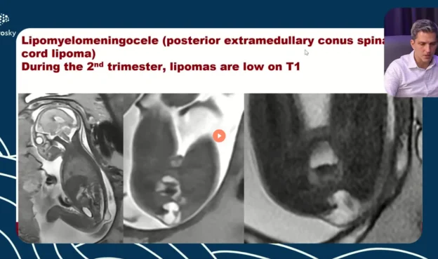 Workshop Disrafismo Espinhal