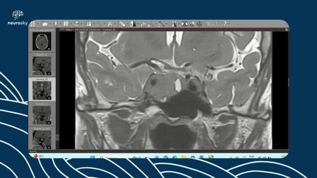 4 Estudos de Caso: Adenomas e Knosp