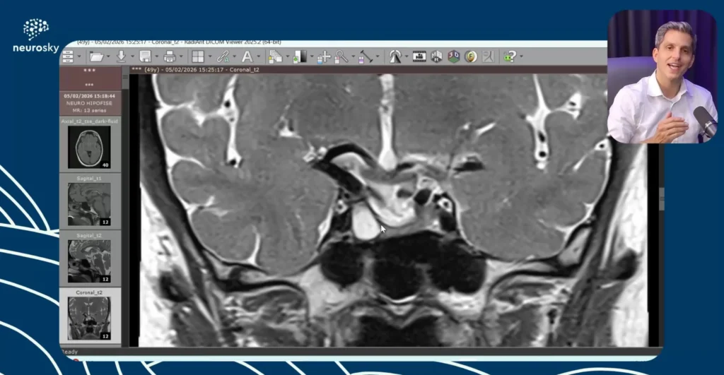 Avaliacao RM Hipofise